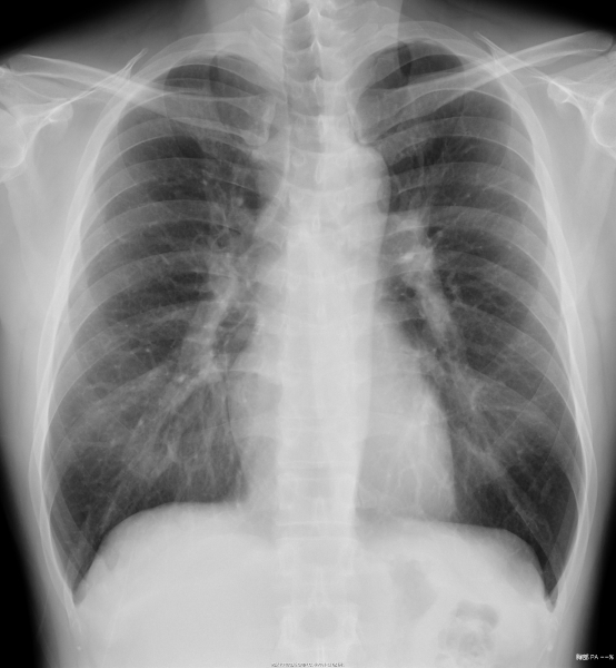 胸部X線撮影